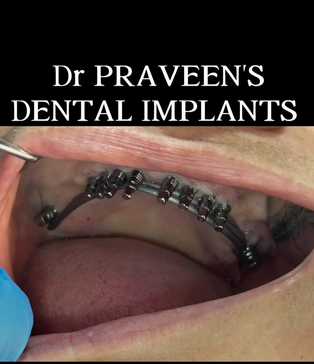 Fixed dentures close-up